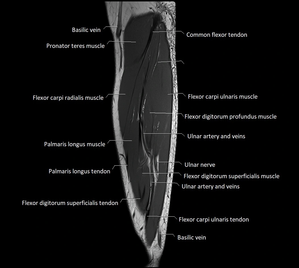 MRI 3T forearm sagittal labelled cross sectional anatomy image 32.webp